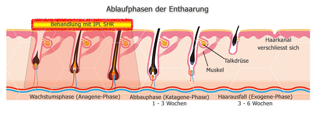 Beauty Elements - SHR Haarentfernung Ablaufphase