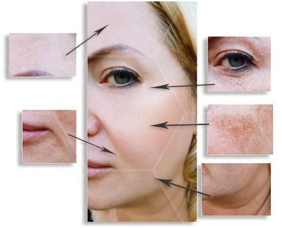 Micro Needling vor&nach