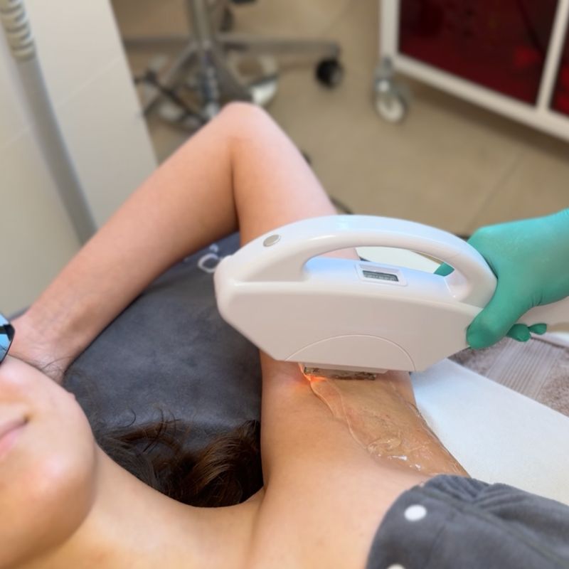 SHR Laser Haarentfernung